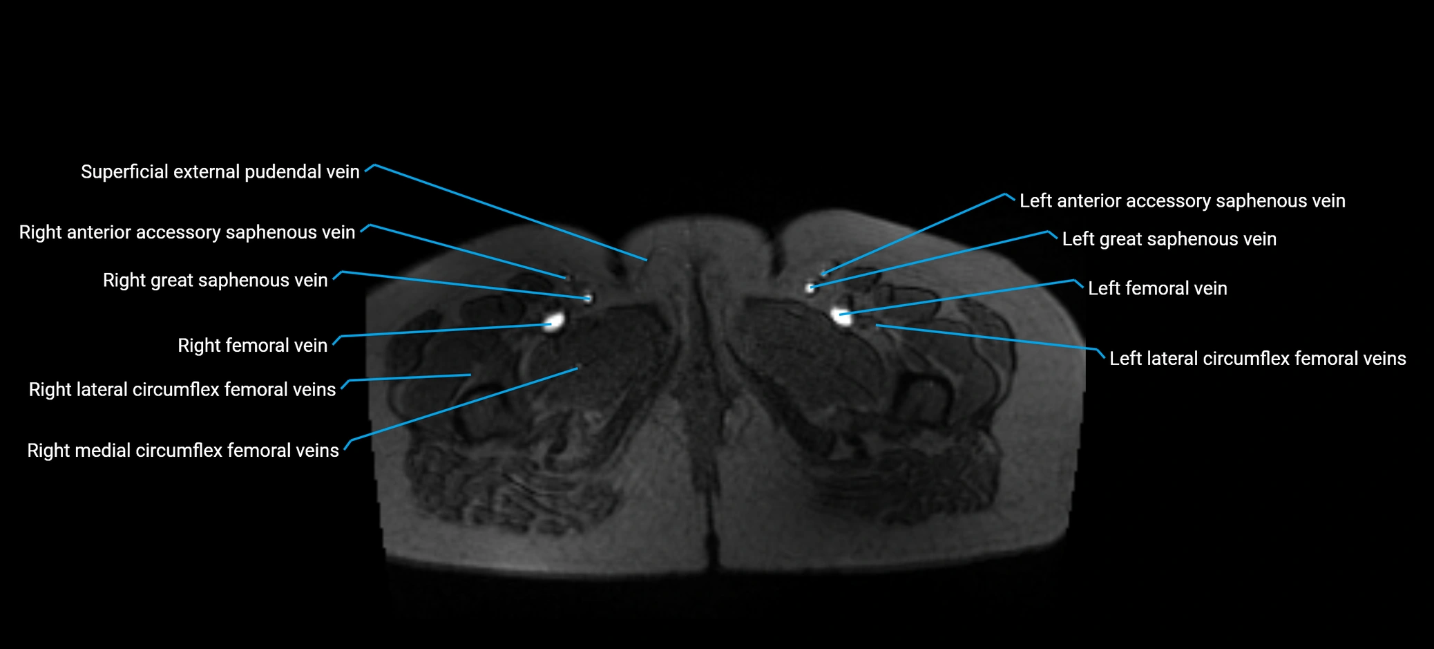 MRV abdomen pelvis & lower limb axial cross sectional anatomy labelled MRI image 205 (1).webp